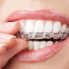 Aparaty ortodontyczne nakładkowe (alignery) - Invisalign