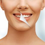 Wybielanie zębów żelem - jednowizytowe