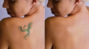 Chirurgiczne usunięcie tatuażu