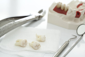 Usuwanie zębów mądrości – ekstrakcja ósemek dolnych