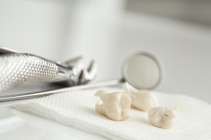 Usuwanie zębów mądrości – ekstrakcja ósemek górnych