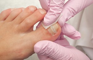 Operacja wrastających paznokci 